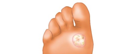 traitement des verrues